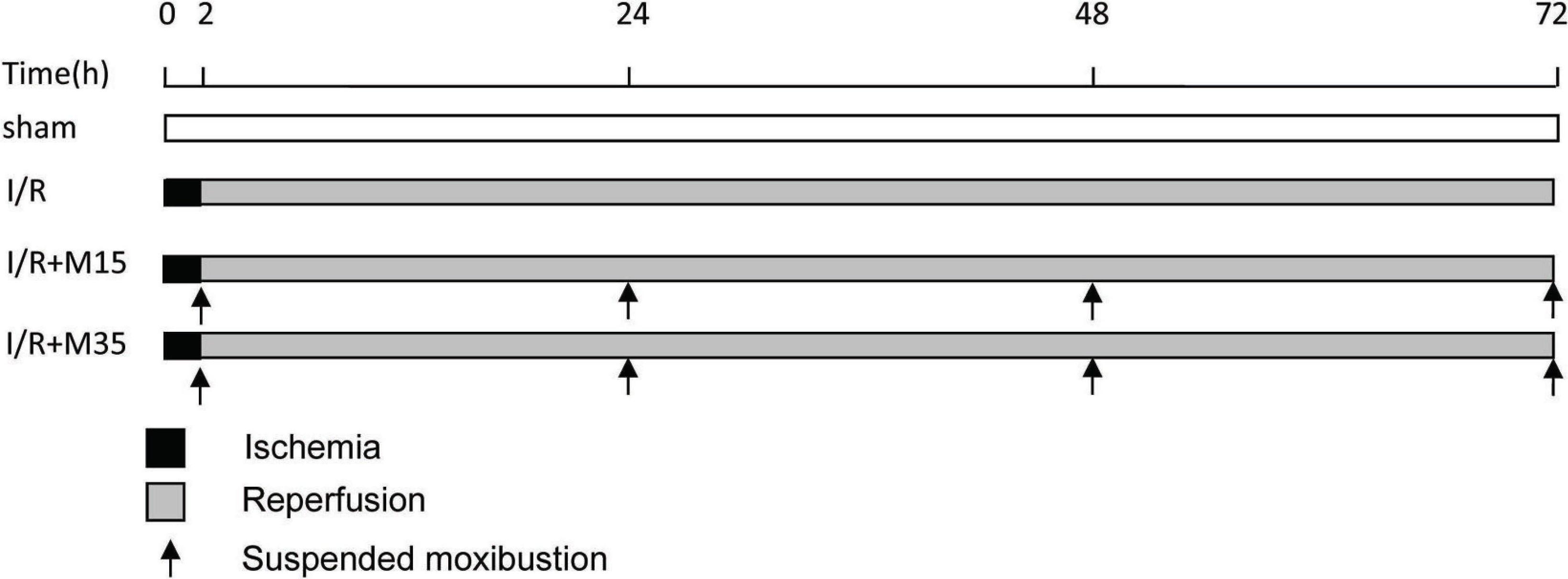 Comparison of 35 minutes and 15 minutes suspended moxibustion on anti-apoptotic effect after focal cerebral ischemia/reperfusion injury in rat